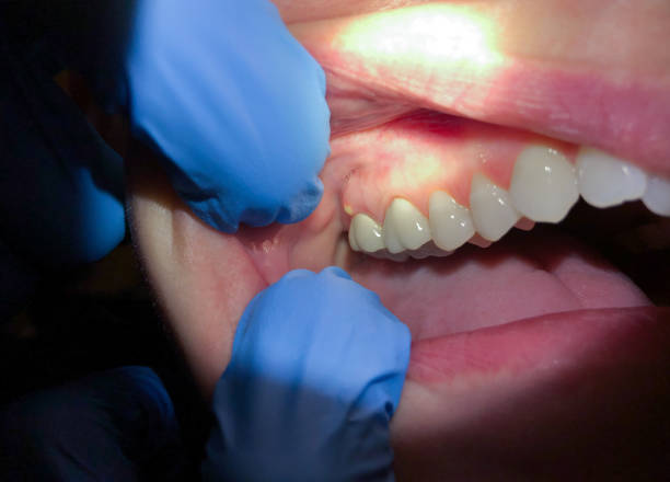 Best Broken or Chipped Tooth Repair in Lake Lifornia, CA