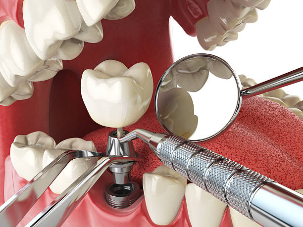 Best Emergency Root Canal Therapy in Lake Lifornia, CA